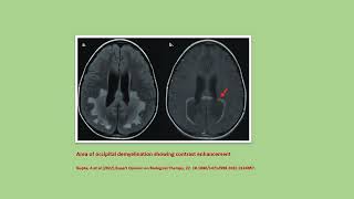 Neurology Quiz 91 Adrenoleukodystrophy [upl. by Sims]