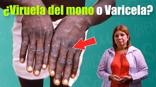 🔸CÓMO DIFERENCIAR LA VARICELA Y LA VIRUELA DEL MONO 🐵 [upl. by Alset188]