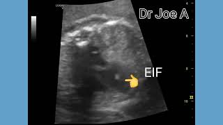 EIF or echogenic intracardiac focus in fetal left ventricle ultrasound and fetal echo video [upl. by Graeme]