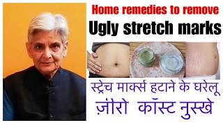 How to remove stretch markshome remedy to cure stretch marksस्ट्रेच मार्क्स हटाने के घरेलू नुस्खे [upl. by Esmaria63]