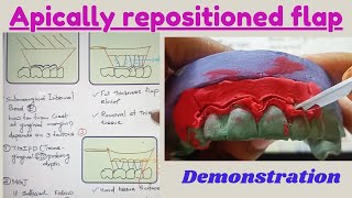 Any dentists can easily learn apically repositioned flap amp bevelled flap with this cast demo [upl. by Quartas202]