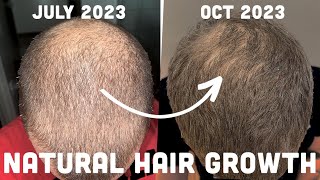 Regrow Your Hair Naturally No Finasteride No Minoxidil [upl. by Eidda]