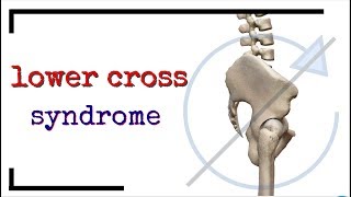 Lower Cross Syndrome and Innominate Rotation [upl. by Nile]