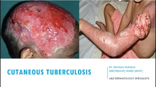 SKINCUTANEOUS TUBERCULOSIS BY DR ABRAHAM TB ulcers funny viralvideo education dermatology [upl. by Toms451]