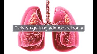 Earlystage lung adenocarcinoma Pioneering insights from scRNA and scTCR integrated analysis [upl. by Hiller10]