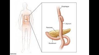 위 전절제술 내시경 영상 total gastrectomy with Roux en Y esophagojejunostomy [upl. by Vasileior]