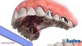 Hyrax palatal expander A form of Rapid Palatal Expansion devices [upl. by Dorfman]