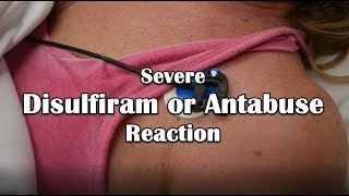 Disulfiram or Antabuse Reaction Emergency [upl. by Idrahs796]