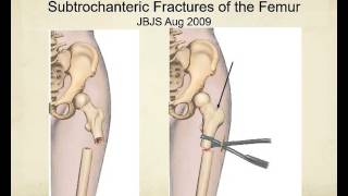 Proximal femur fractures how to identify and avoid malreduction malrotation [upl. by Clotilde]