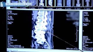 FACET SYNDROME AFTER TRANSFACET DECOMPRESSION BY DR TONY MORK [upl. by Ailimat737]