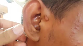 Double Ear  Pre auricular skin tags [upl. by Araed]