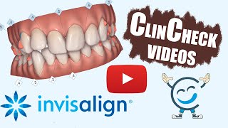 Invisalign ClinCheck Videos For Various Teeth Conditions [upl. by Suiraj]