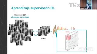 IA en Radiografía de Tórax Webinar [upl. by Iridissa731]