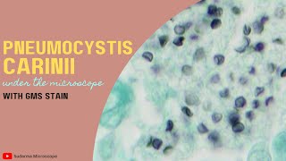 Pneumocystis carinii under the microscope with Gomoris Methenamine Silver GMS stain [upl. by Kcirtapnaes]