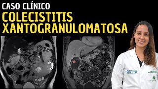 Caso clínico 110 Colecistitis xantogranulomatosa [upl. by Eimaj355]