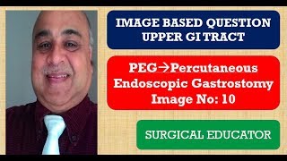 PERCUTANEOUS ENDOSCOPIC GASTROSTOMY UPPER GI TRACT Image Based Question [upl. by Yduj]