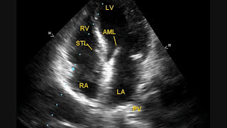 Mild Tricuspid Regurgitation With Borderline Pulmonary Hypertension [upl. by Abehshtab]