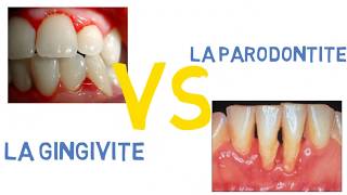 Gingivite VS parodontite [upl. by Duggan]