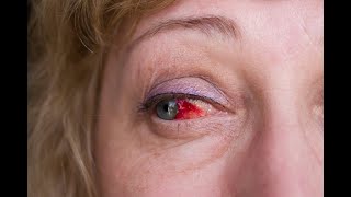 Subconjunctival Hemorrhage  Causes Signs amp Symptoms Treatment [upl. by Naltiac214]