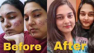 MY ACNE JOURNEY  MY EXPERIENCE WITH ISOTRETINOIN  HOW I CLEARED MY ACNE  USE OF TRETINOA005 [upl. by Aynwat]