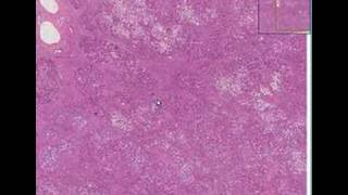 Histopathology LiverCirrhosis micronodular [upl. by Nnylsaj]