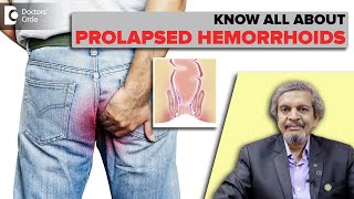 HemorrhoidsProlapsed HemorrhoidsTypes of Hemorrhoids amp Treatment DrRajasekar M RDoctors Circle [upl. by Aivekahs508]