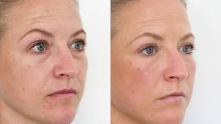 Tear Trough Treatment using Dermal Filler [upl. by Neau]