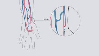 Understanding hemodialysis [upl. by Bland502]