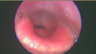 Drug Induced Sleep Endoscopy  rare laryngeal obstruction seen [upl. by Taveda]