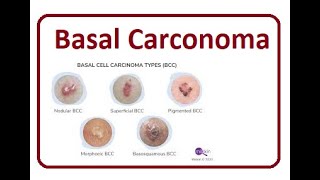 Basal Cell Carcinoma  2024 [upl. by Sholom768]