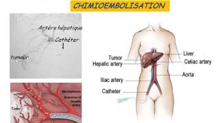 GASTROENTEROLOGIE tumeurs malignes du foie 2016 [upl. by Airemaj]