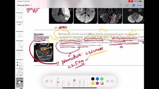 Neonatal intraventricular hemorrhage neurology 79  First Aid USMLE Step 1 in UrduHindi [upl. by Eeryk]