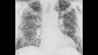 FIBROSIS PULMONAR CAUSAS SÍNTOMAS DATOS CLÍNICOS IMÁGENES Y TRATAMIENTO [upl. by Ytissac238]