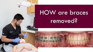 HOW are braces removed  Dr Jiten Vadukul  The Orthodontist [upl. by Ner]