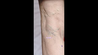 Symptoms of vein disease [upl. by Yrrah]