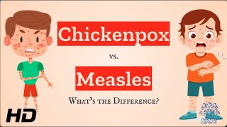 Chickenpox vs Measles Which is Which [upl. by Steinke]