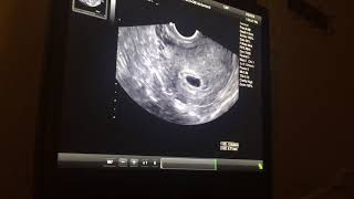 Pregnancy ultrasound 5 weeks and 5 days [upl. by Cram323]