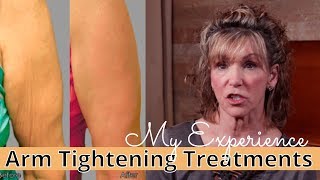 My Experience with USRF Exilis Ultra NonSurgical Skin Tightening for Arms amp Neck [upl. by Oynotna]