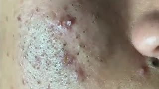 Cheeks Full of Ugly BLACKHEADS 😢 Acne Treatment for Blackheads Whiteheads Milia [upl. by Rihsab]