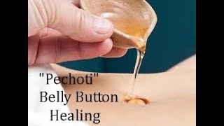 Pechoti Belly button Healing [upl. by Ojeillib]