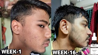 derma roller and minoxidil beard growth results  man matters beard oil review  beard growth tips [upl. by Alcine]