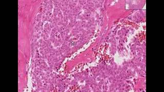 Histopathology OvaryGranulosa cell tumor [upl. by Aurlie]