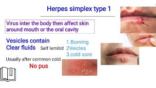 herpes simplex infection الهيربس [upl. by Malka]