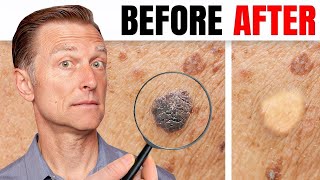 How to Remove Skin Tags and Warts Overnight  Dr Berg Explains [upl. by Veator480]