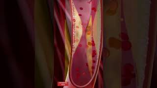 Angioplasty l Coronary artery Stenting l Animation heartattack shorts [upl. by Aneis]