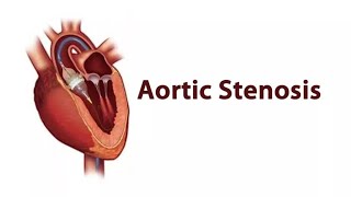 MRCP PACES AORTIC STENOSIS Station Three Cardiology [upl. by Lleumas539]