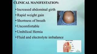 Ascites Digestive System Disorder [upl. by Solitta464]