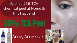 25 TCA chemical Peel At Home  in Hindi मैंने पहली बार अपने चेहरे पर 25 TCA Peel लगाया हैं [upl. by Katerina]