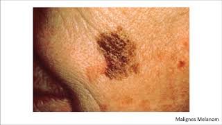 Dermatologie Blickdiagnosen  Krankheitsbilder [upl. by Eittocs]