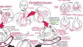 Emphysema  Pathophysiology COPD [upl. by Cr56]